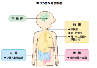 NENの主な発生部位