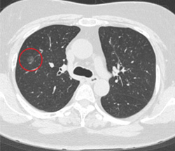 CTで発見された淡い陰影の 早期肺がん例