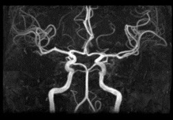 脳検査（MRI・MRA）