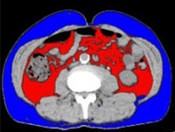 内臓脂肪測定CT検査