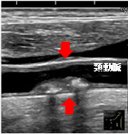 頸動脈エコー検査